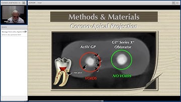 GTX Thermilfil and EndoSequence comparison - Dr. Sergio Kuttler | Dentsply Sirona