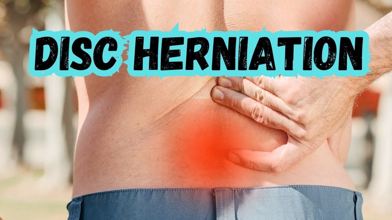 Disc Herniation • Simplified • Physical Therapist YouTube