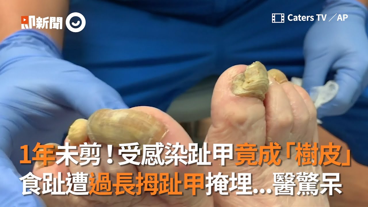 處理1年未剪受感染的腳趾甲 樹皮般拇趾甲掩埋食趾 醫生驚呆 療癒體驗 Youtube