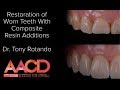 Restoration of Worn Teeth with Composite Resin Additions