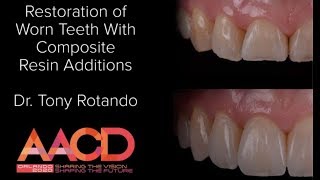 Restoration of Worn Teeth with Composite Resin Additions