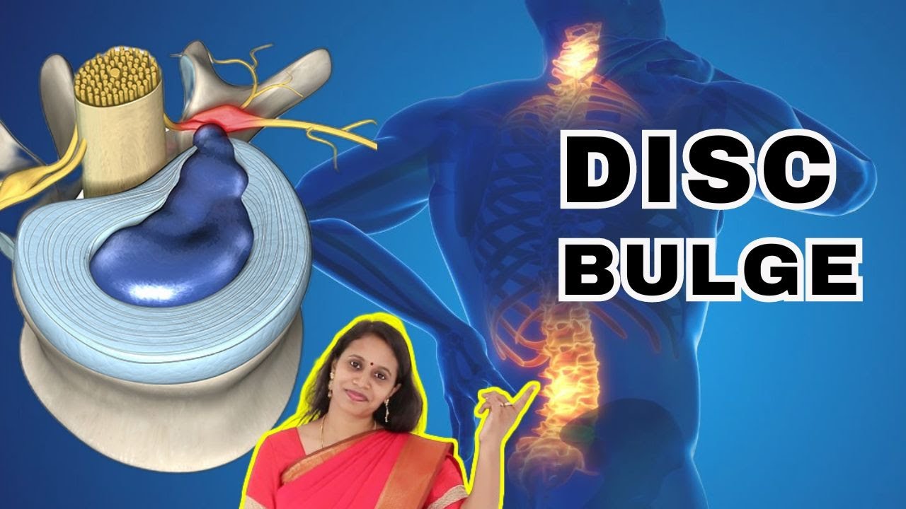 Back pain disc problem treatment in Tamil. இடுப்பில் பயங்கர வலி- அறுவை சிகிச்சை மட்டும் தான் தீர்வா?