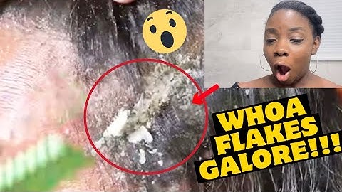 REACTING TO EXTREME DANDRUFF SCRATCHING | Dry Itchy Scalp & Huge Flakes #6