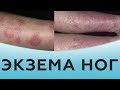 Экзема ног