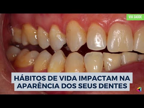 Hábitos de vida impactam na aparência dos seus dentes | Via Saúde