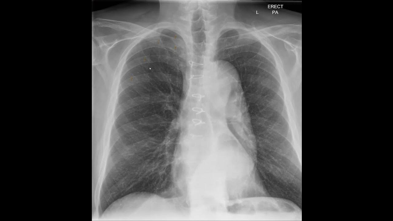 Identifying and counting ribs on chest X=ray PA view YouTube
