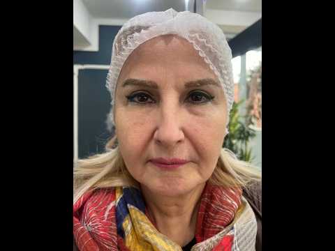 ليفت نخ توسط دكتر رضا كريمي  نخ نخ لیفت