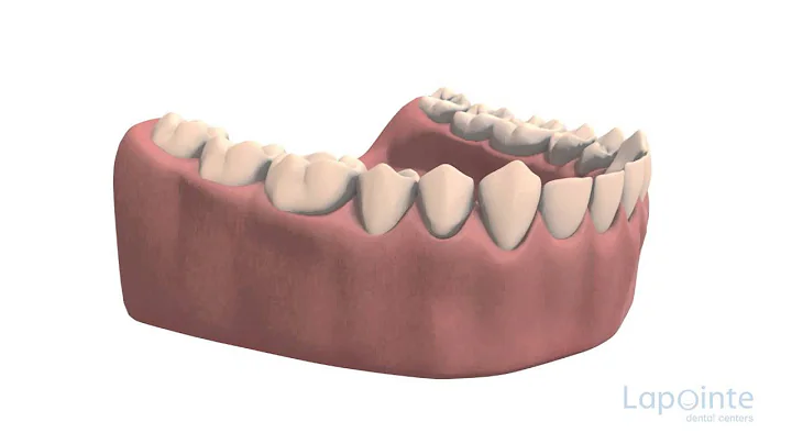 Clinical crown lenghthening - Lapointe dental cent...