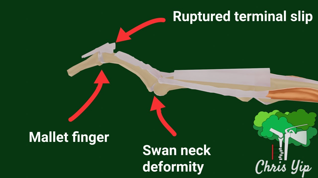 Pathophysiology Of Mallet Finger And Swan Neck Deformity animated pathophysiology-of-mallet-finger-and-swan-neck-deformity-animated