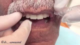 طقم اسنان متحرك د سامي سعيد ..complete denture dr Sami Saeed