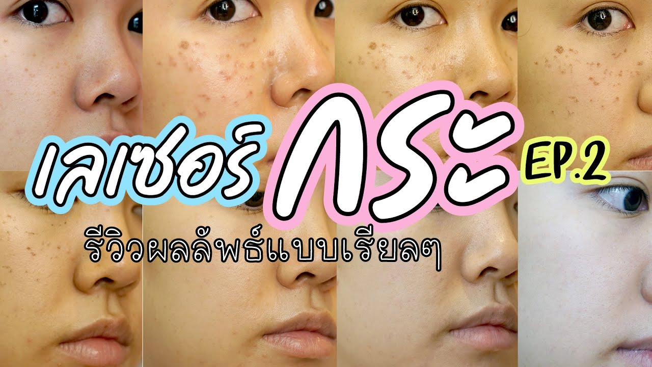 เลเซอร์กระ EP.2 อัพเดทผลลัพธ์หลังเลเซอร์ หน้าใสจริงมั้ย  กระขึ้นเพิ่มได้อีกมั้ย | Noonninn