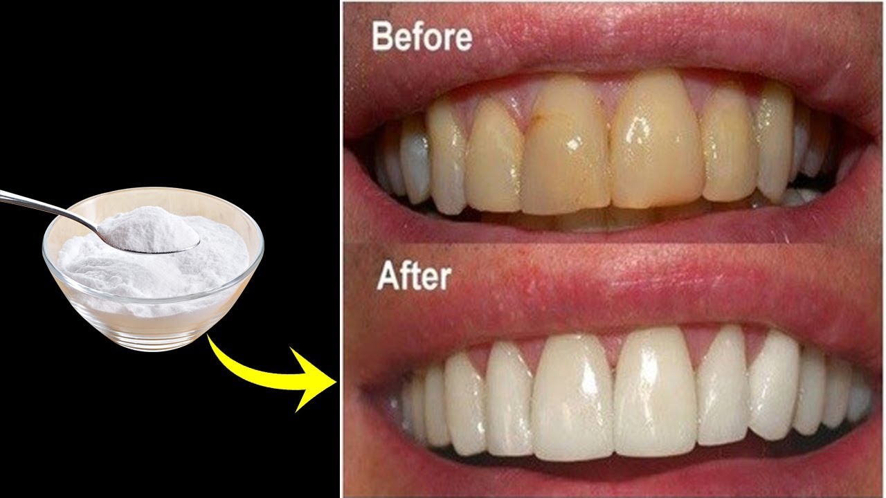 Does Brushing Your Teeth With Baking Soda Whiten Your Teeth
