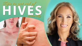Hives | How to Get Rid of Hives Naturally | Dr. J9 Live
