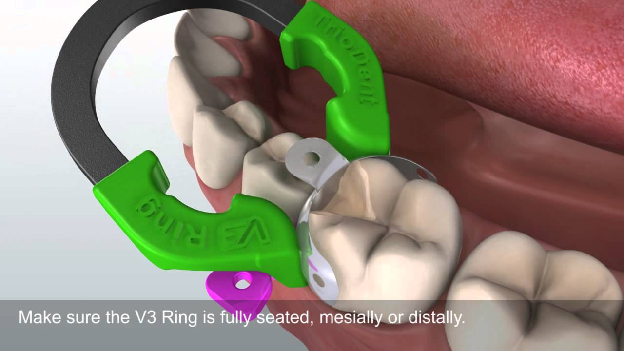 Posterior Composite With V3 Sectional Matrix System Sub Titles Youtube