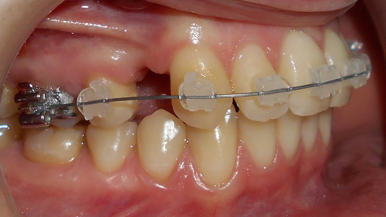 تصحيح انحراف الخط الأوسط السني العلوي عن طريق القلع أحادي الجانب على الفك العلوي فقط