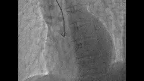 Advancing the diagnostic catheter to cannulate the right coronary artery
