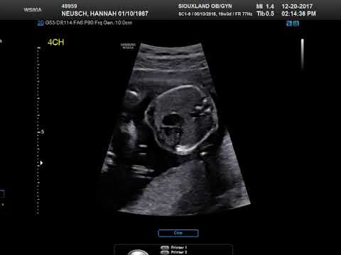 20 Week Ultrasound with EIF (calcification in heart) - YouTube