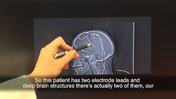 Davis_Brain Stimulation_Explore Research
