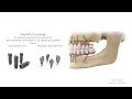 Stepbystep procedure smartfix concept  for astra tech implant system ev  dentsply sirona