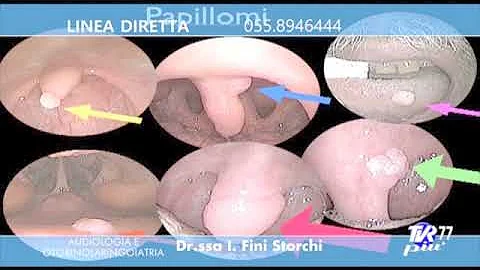 Come inizia il cancro alla gola?