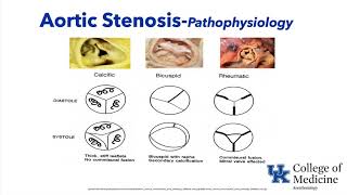 Valvular Heart Disease  Dr. Schell