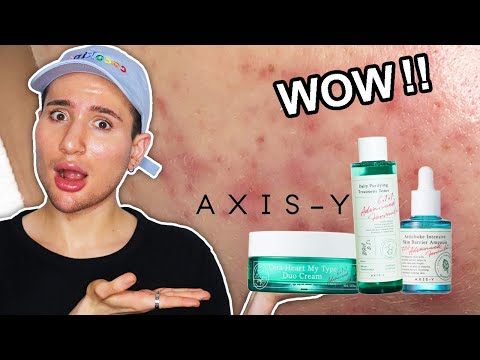 Fade ACNE MARKS! How to Get Rid of DARK SPOTS and HYPERPIGMENTATION in WINTER! (with AXIS-Y)