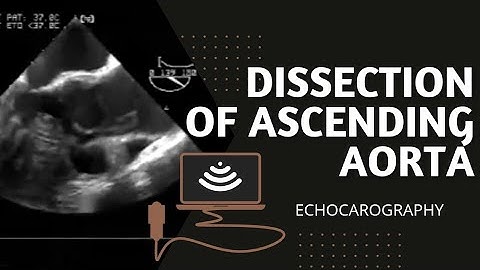 Dissection of ascending aorta (Type A) #echo #cardiology