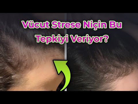 Strese Bağlı Saç Dökülmesi [Telogen Effluvium]