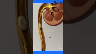 How kidney stone are naturally removed |Kidney stone treatment