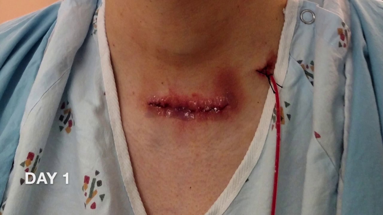 thyroidectomy scar progression 1 year youtube