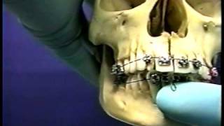 3rd-Braces Definition of Terms