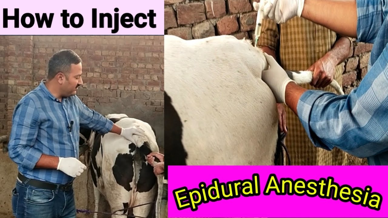 Usman Injection Epidural Anesthesia || How to inject Epidural Injection By Dr. Usman ...