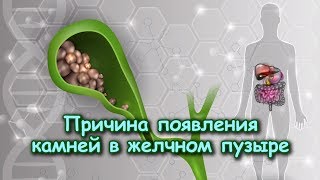 Окаменевшая агрессия: КАМНИ В ЖЕЛЧНОМ ПУЗЫРЕ Окаменевшая агрессия: КАМНИ В ЖЕЛЧНОМ ПУЗЫРЕ