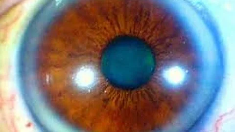 Why do I have a blue circle around my brown eyes?