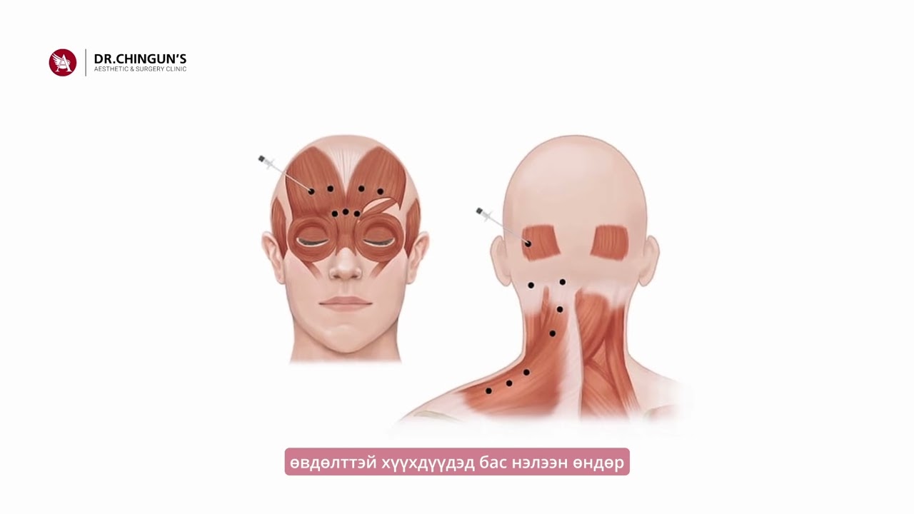 ЭМЧ ТАЙЛБАРЛАХ НЬ: 12.БОТОКС ТАРИЛГА