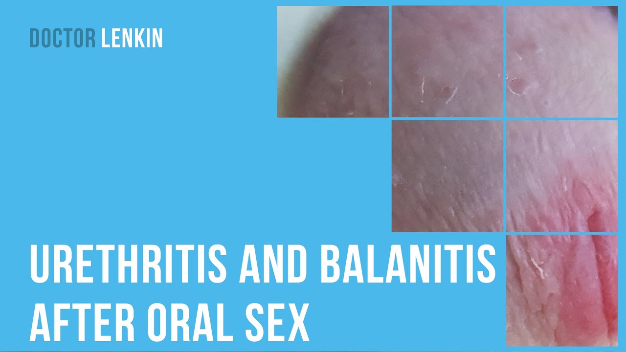 Urethritis And Balanitis After Oral Sex Youtube