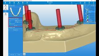 RealGUIDE Software:  Reconstruction Setup- Part 2 Net Worth