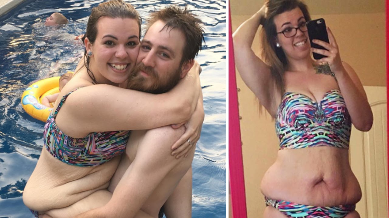 Mom Who Lost 130 Pounds Bares Loose Skin to Show Realities of Weight Loss 