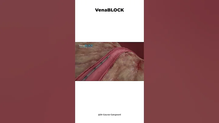 Latest and most advanced treatment of varicose veins | Venablock glue | 3d animation | Dr. Gaurav G.