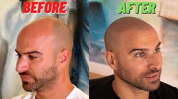 SUPER NATURAL Scalp Micropigmentation Before and After w/ Matt Iulo