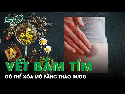 Video Vết Bầm Tím: Xóa Tan Nhờ 6 Cách Dùng Thảo Dược Này|... - youtube