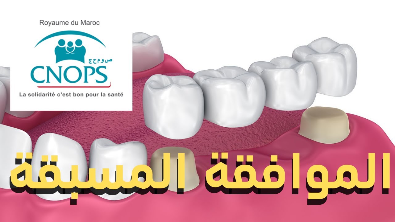 CNOPS الموافقة المسبقة عن علاجات الأسنان ( بريدج، تقويم..) من طرف كنوبس