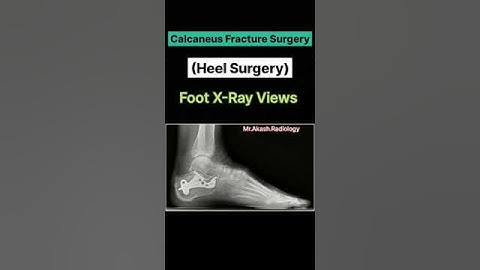 🦴🙋🏻‍♂️Calcaneus Fracture Surgery (Heel Surgery)| Foot X-Ray #xray #shorts #viral #radiology #medical