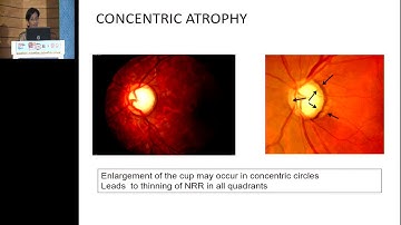AIOC2019   GP1   Topic   Evaluation of Optic Disc in Glaucoma & OD Suspects   Dr Prabhudesai Medha N