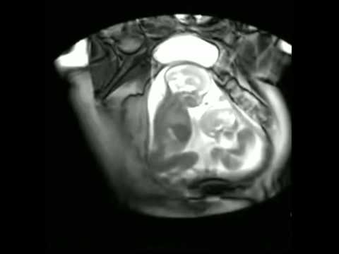 twin-babies-caught-on-mri-scan-fighting-in-their-mothers-womb