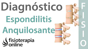 ¿Es la espondilitis lo mismo que la artritis EA?