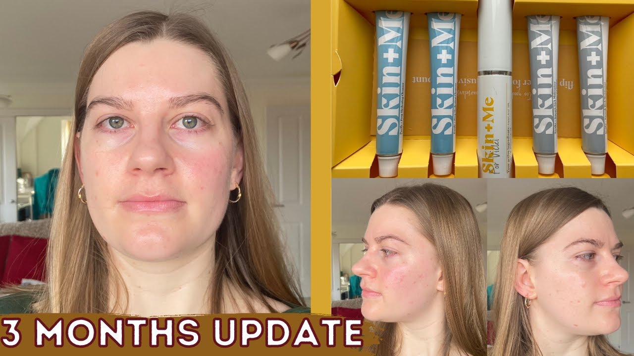 Skin + Me 3 Month Review // Did It Help My Redness & Sensitivity?