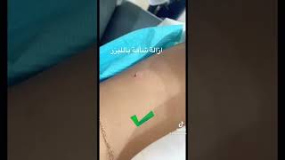 ازالة الشامات بدقائق