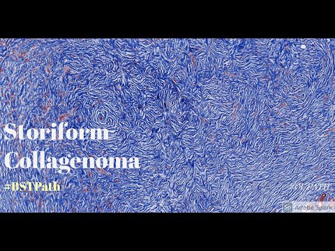 Video: Jenis Fibroid - Fibroma Desmoid, Non-pengerasan, Fibroma Non-osteogenik Dan Kistik