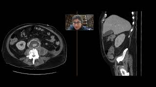 Discitis-Osteomyelitis